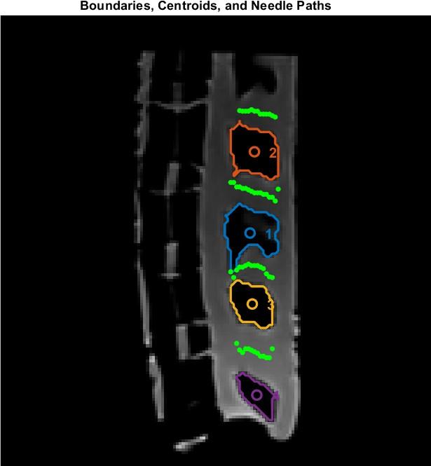 MATLAB-generated visualization showing computed optimal needle paths overlaid on vertebrae image